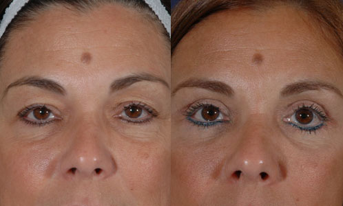 Before and After Image: Patient # 61736 - front