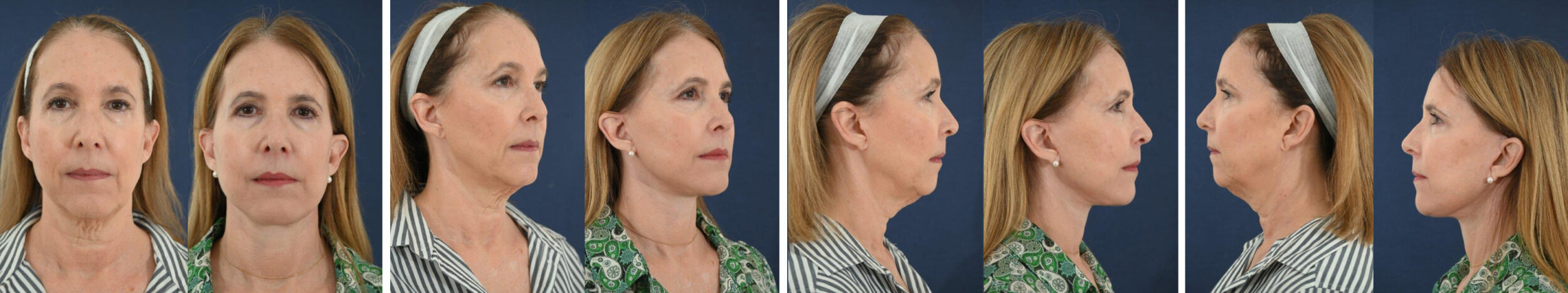 Before and After Image: Patient # 74431 - other