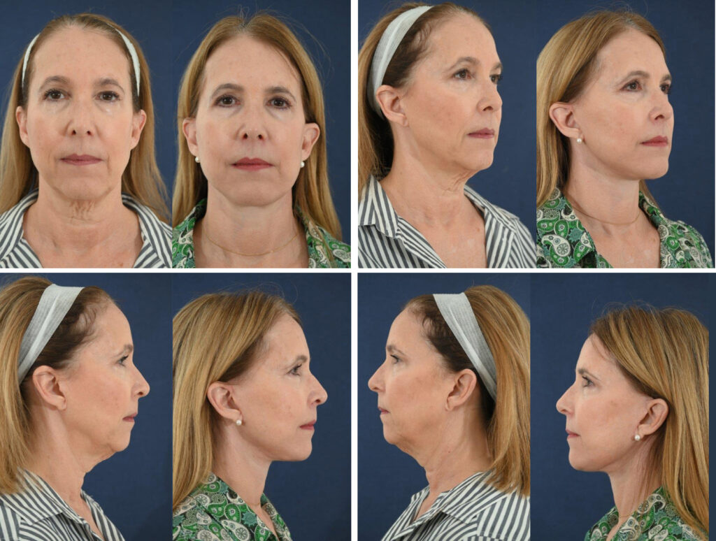 Before and After Image: Patient # 74431 - other