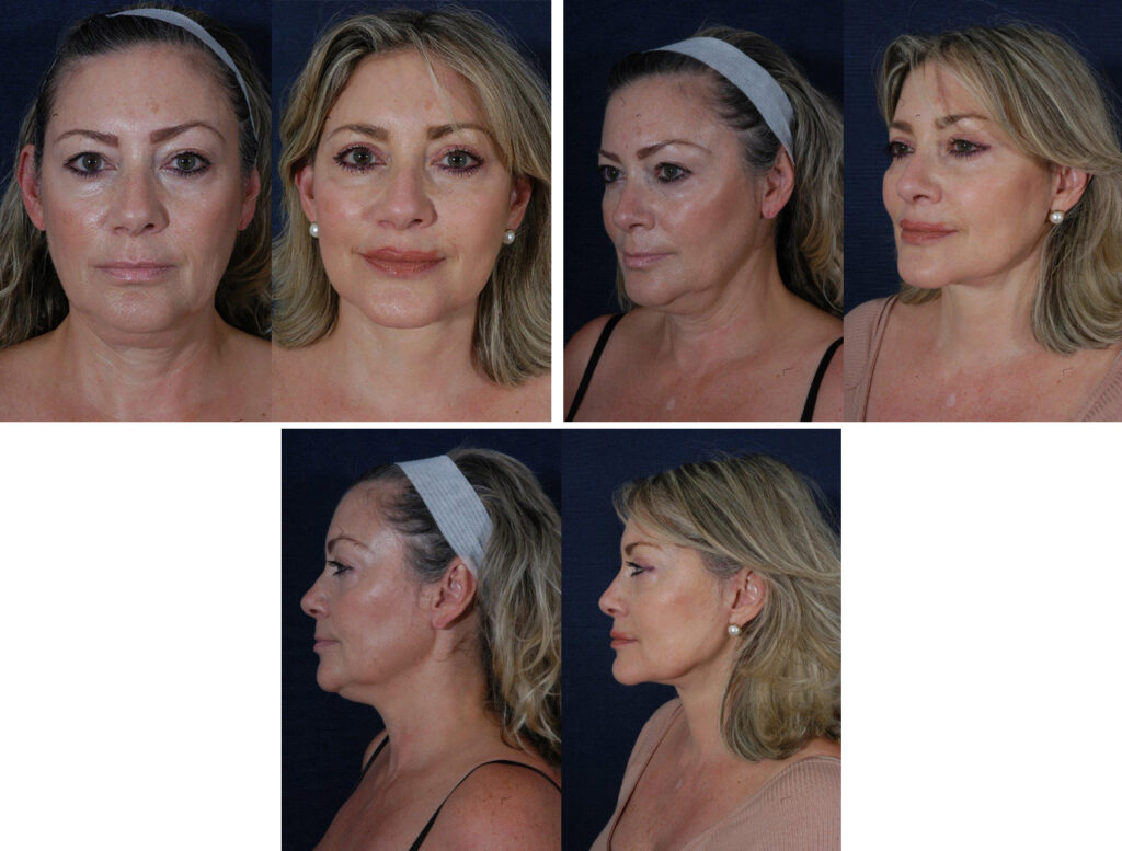 Before and After Image: Patient # 62148 - other