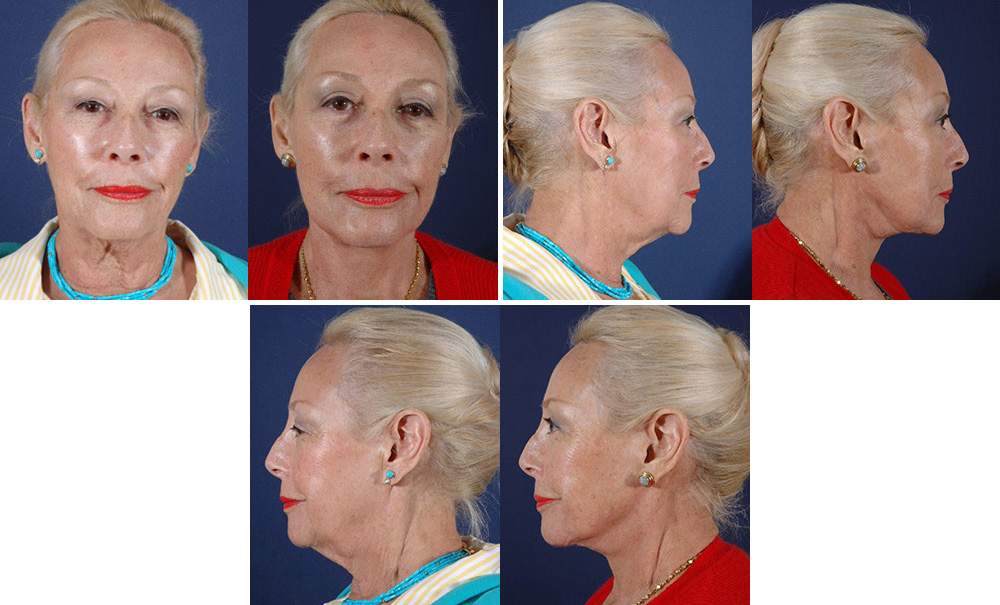 Before and After Image: Patient # 63866 - other