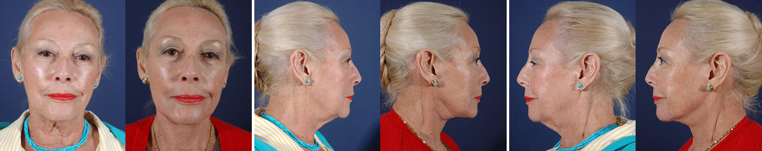 Before and After Image: Patient # 63866 - other