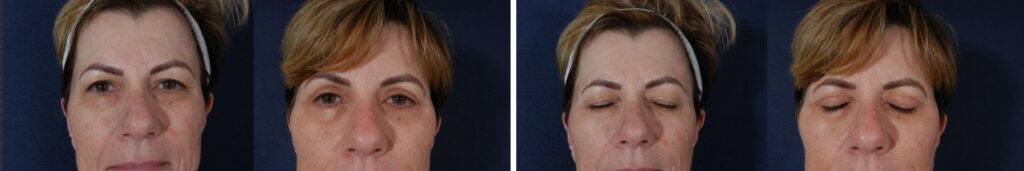 Before and After Image: Patient # 84715 - front