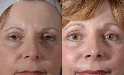 Before and After Image: Patient # 99194 - front