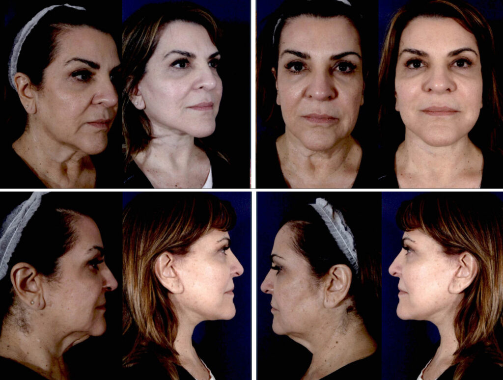 Before and After Image: Patient # 14195 - other