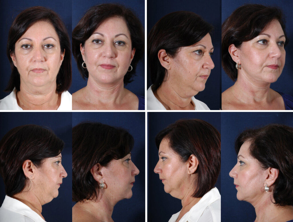 Before and After Image: Patient # 17989 - other