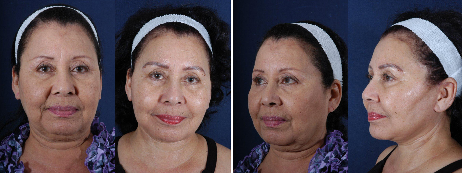 Before and After Image: Patient # 32858 - other