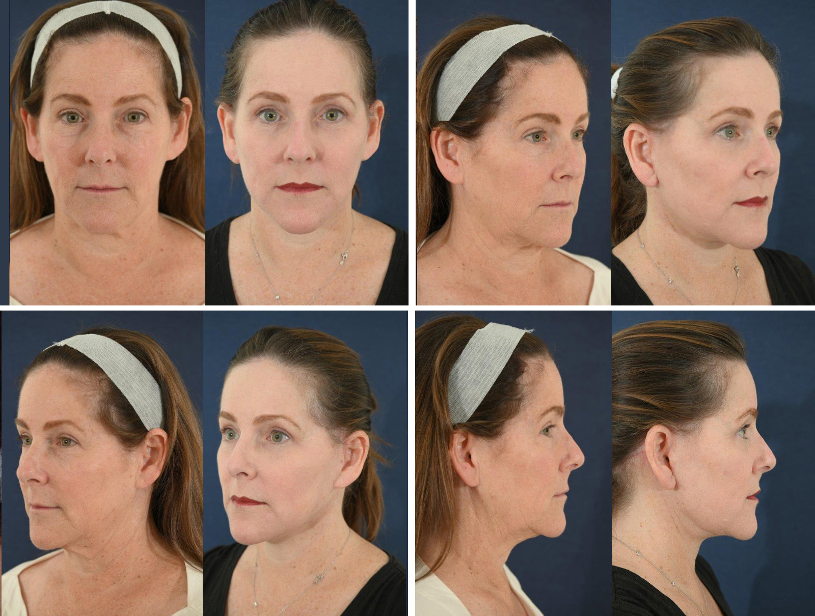 Before and After Image: Patient # 42343 - other