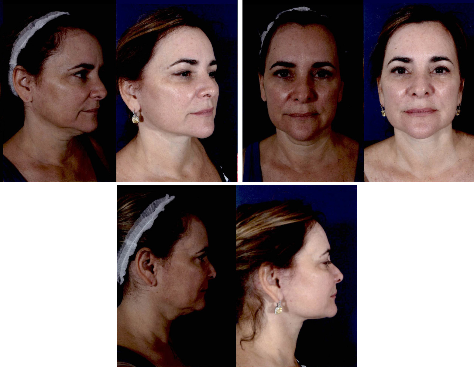 Before and After Image: Patient # 42396 - other