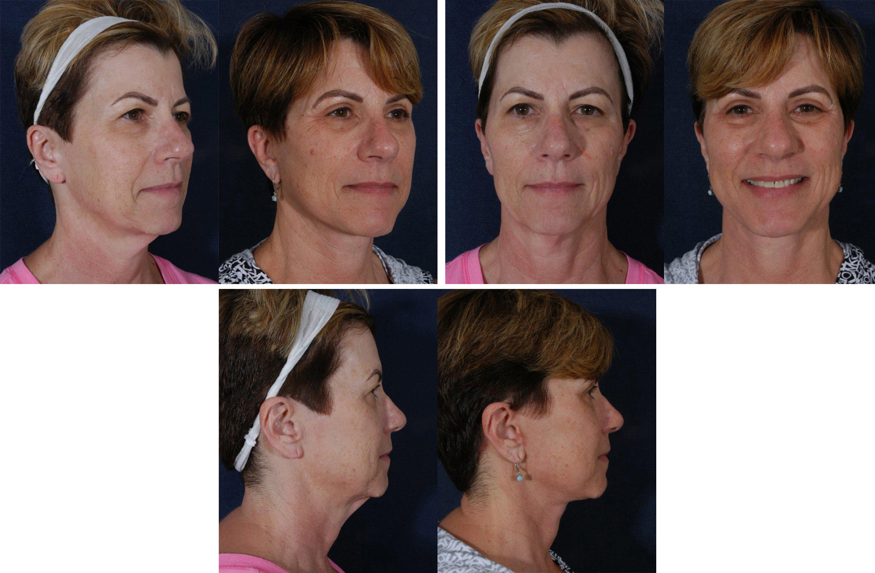 Before and After Image: Patient # 44742 - other