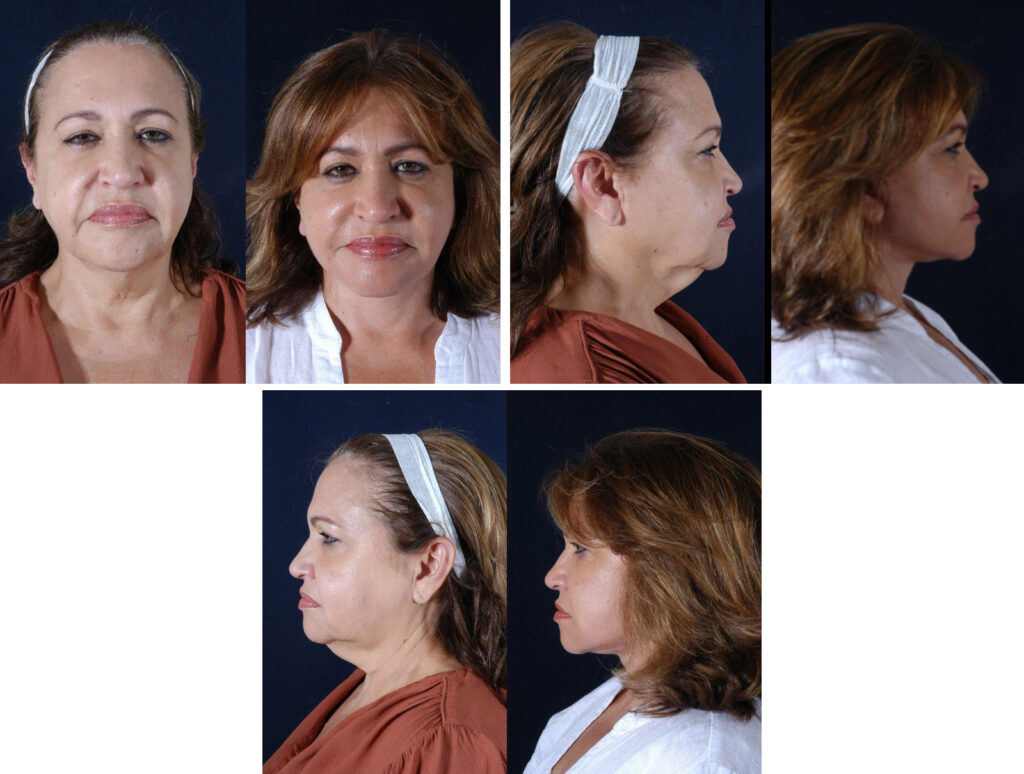 Before and After Image: Patient # 51266 - other