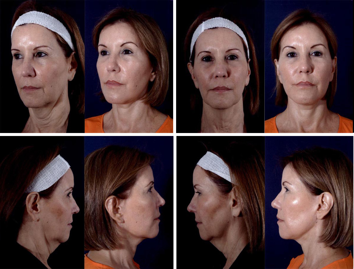 Before and After Image: Patient # 51425 - other