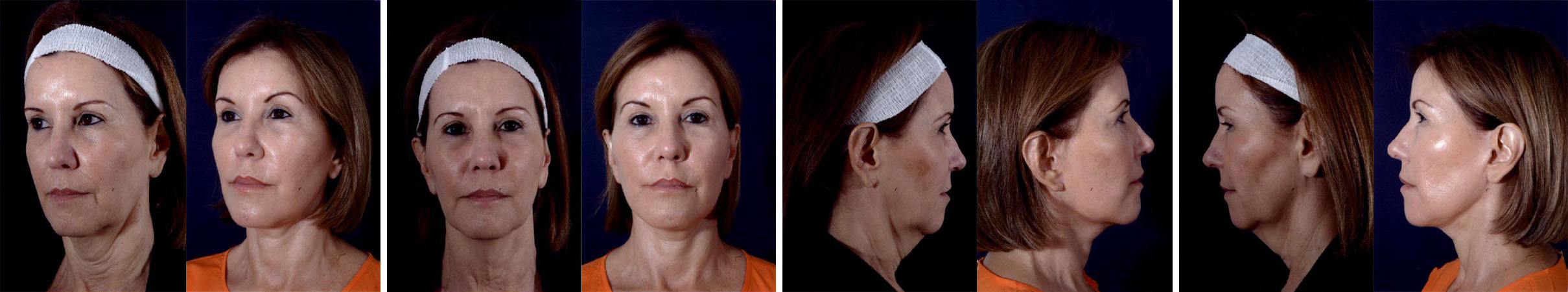 Before and After Image: Patient # 51425 - other