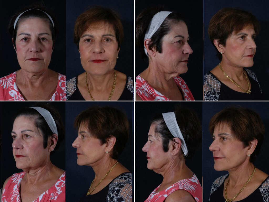 Before and After Image: Patient # 58080 - other
