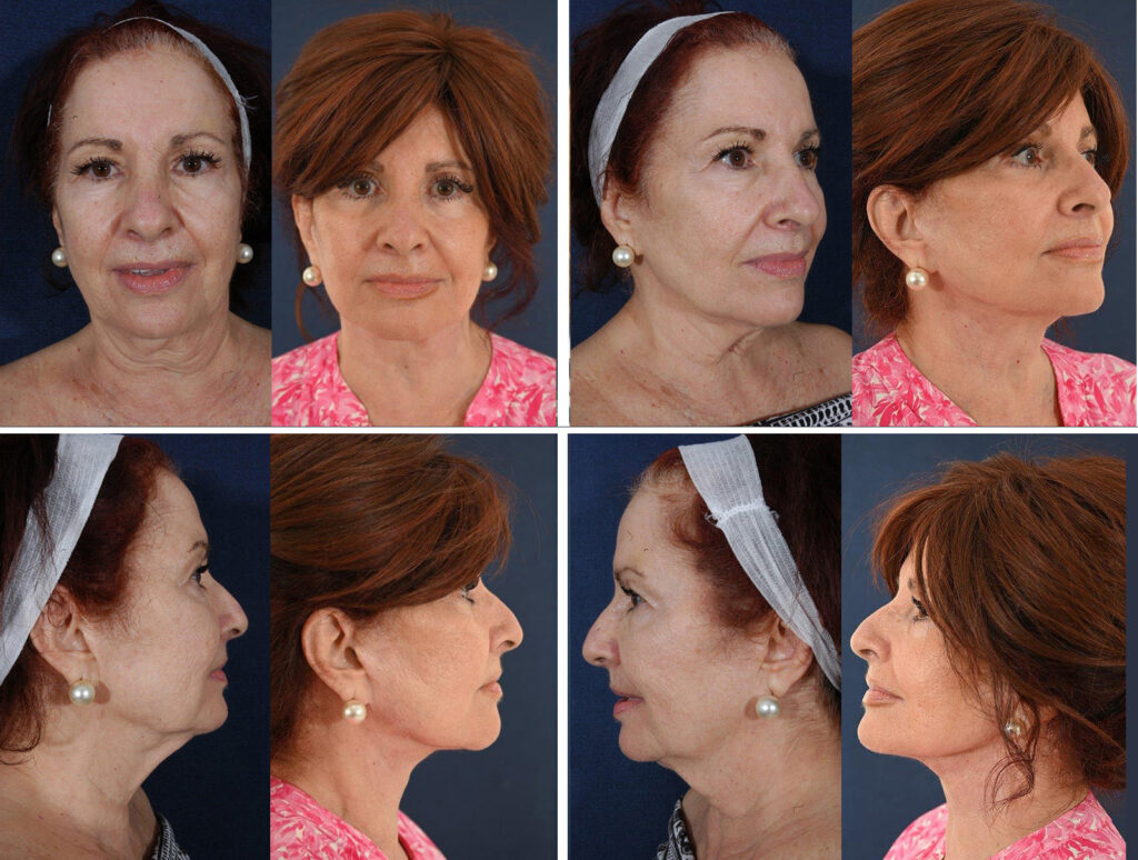 Before and After Image: Patient # 67525 - other