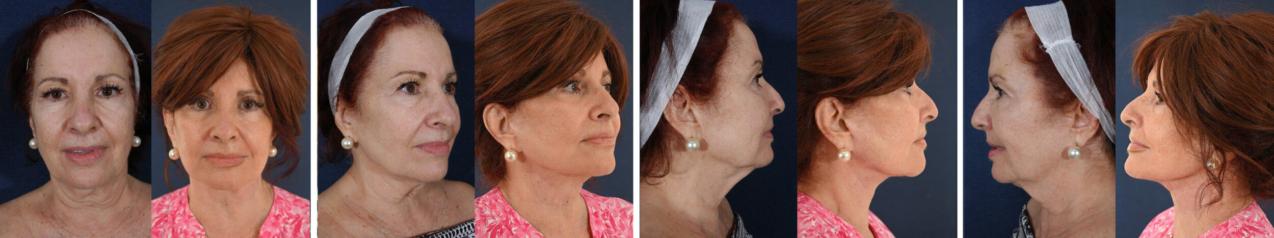 Before and After Image: Patient # 67525 - other