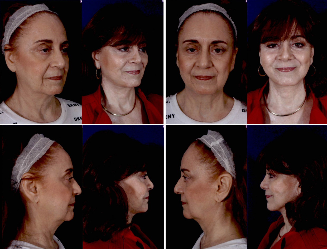 Before and After Image: Patient # 68634 - other