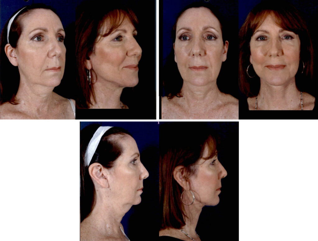 Before and After Image: Patient # 68956 - other