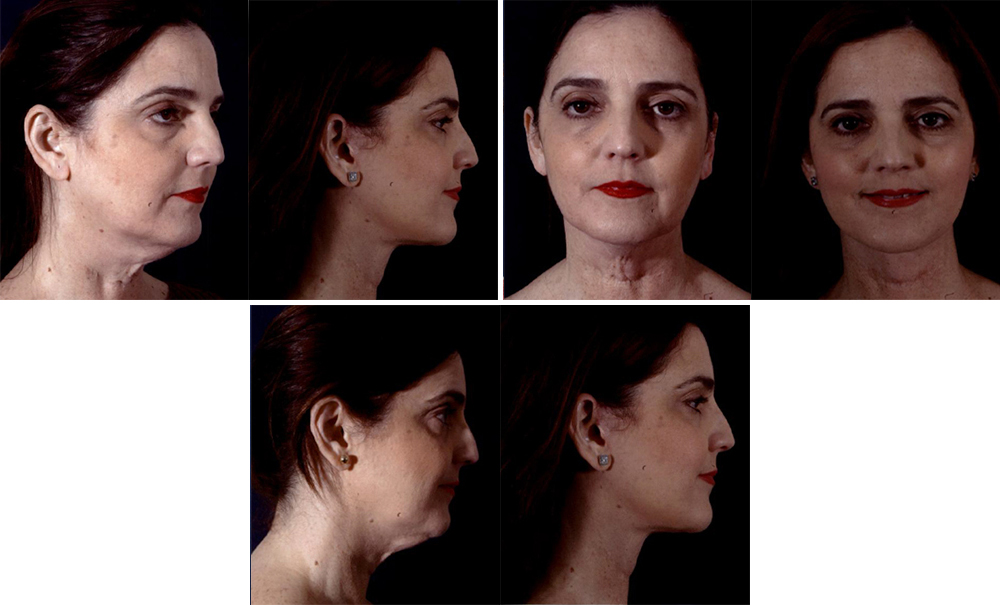 Before and After Image: Patient # 71128 - other