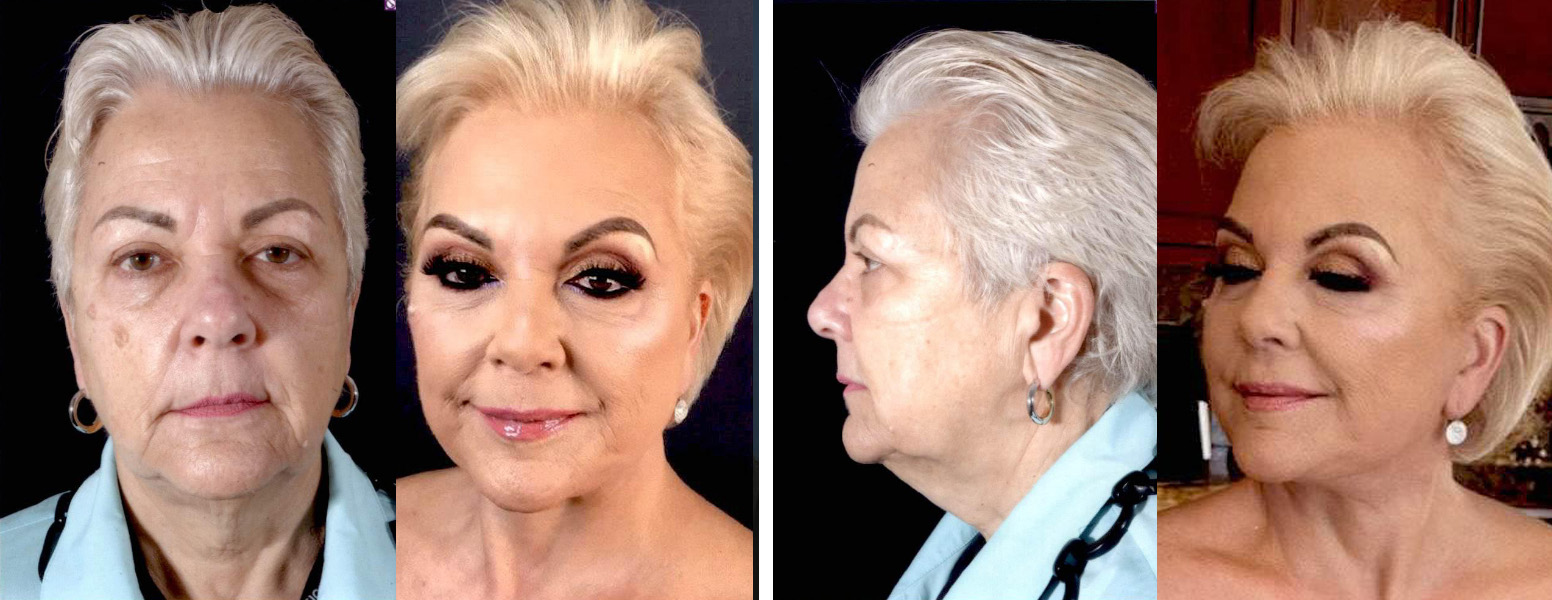 Before and After Image: Patient # 74301 - other