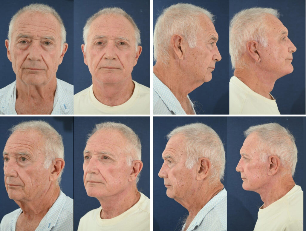 Before and After Image: Patient # 75011 - other