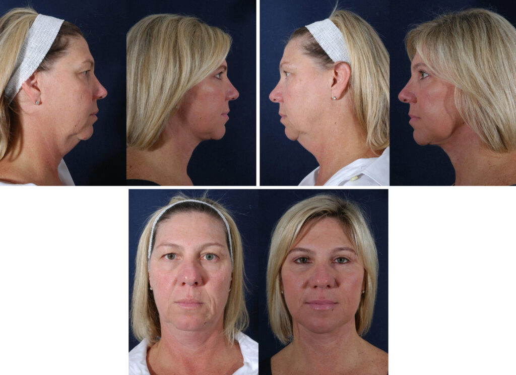 Before and After Image: Patient # 78700 - other