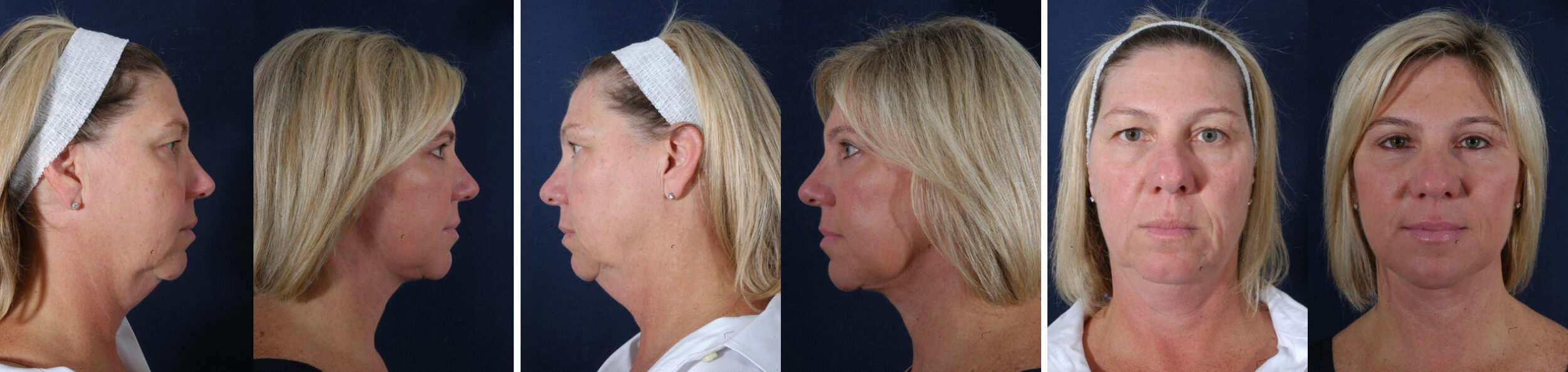 Before and After Image: Patient # 24628 - other