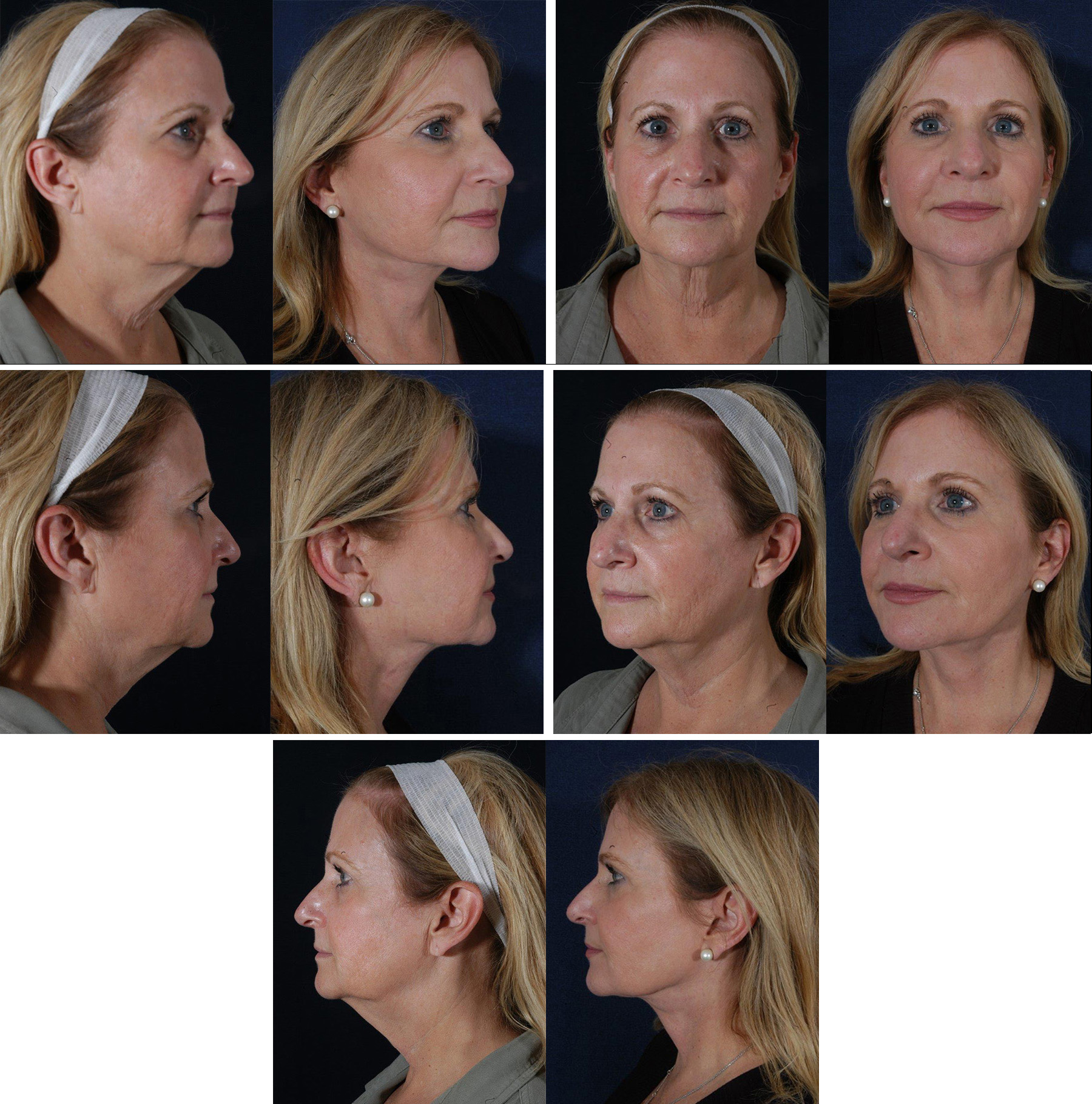 Before and After Image: Patient # 87726 - other