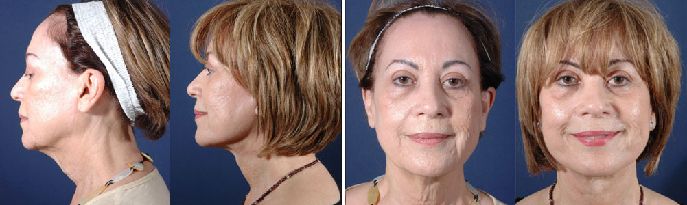 Before and After Image: Patient # 90501 - other