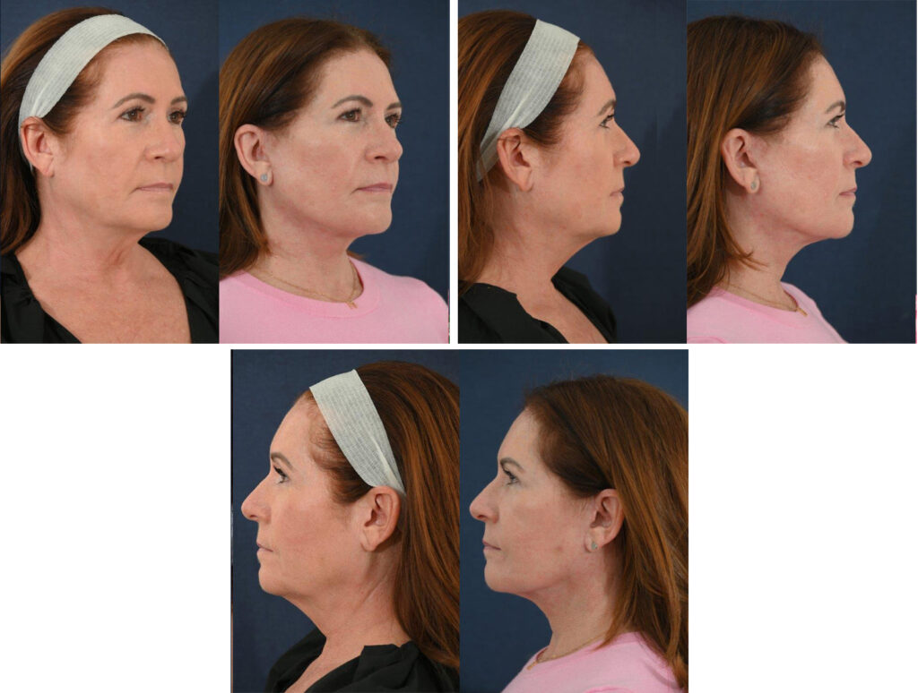 Before and After Image: Patient # 97181 - other