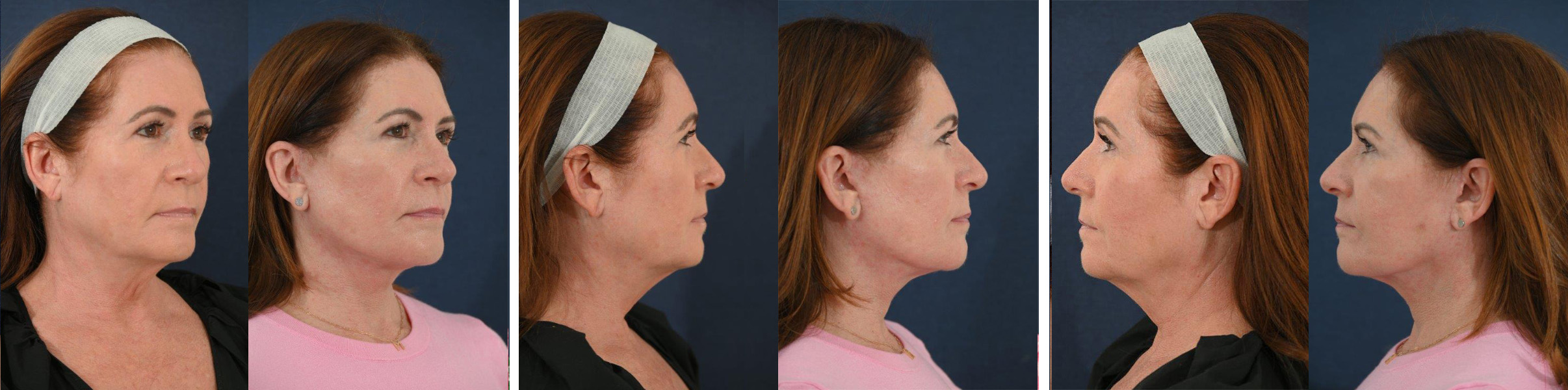 Before and After Image: Patient # 97181 - other