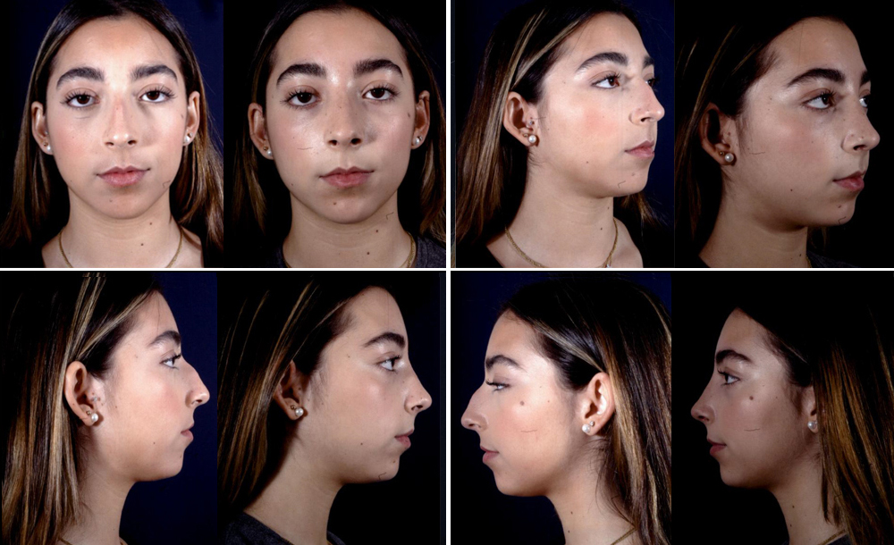 Before and After Image: Patient # 28124 - other