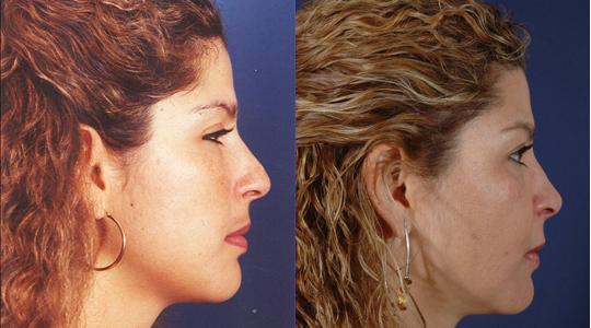 Before and After Image: Patient # 30919 - right-side