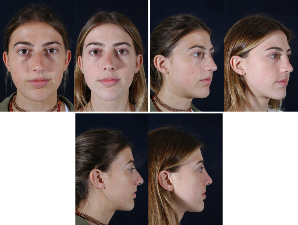 Before and After Image: Patient # 33432 - other
