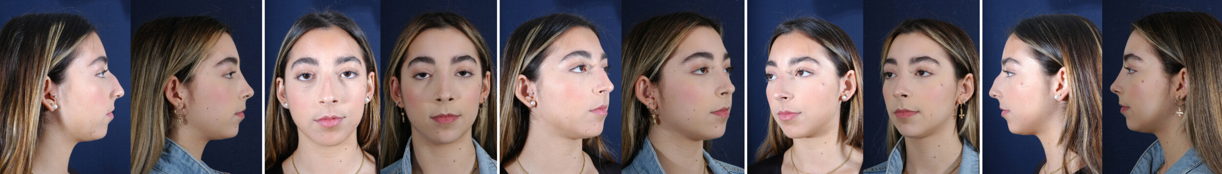 Before and After Image: Patient # 34174 - other