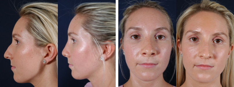 Before and After Image: Patient # 51159 - other