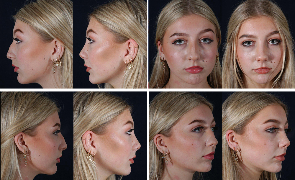 Before and After Image: Patient # 64649 - other