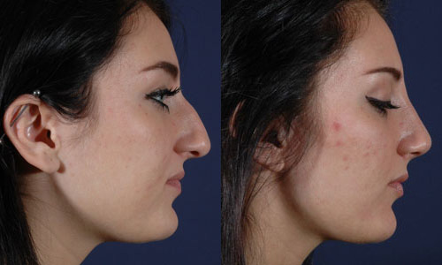 Before and After Image: Patient # 81679 - right-side