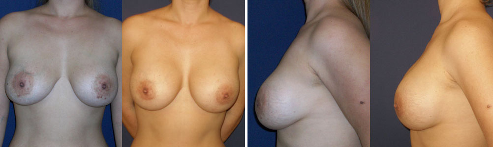 Before and After Image: Patient # 13333 - other