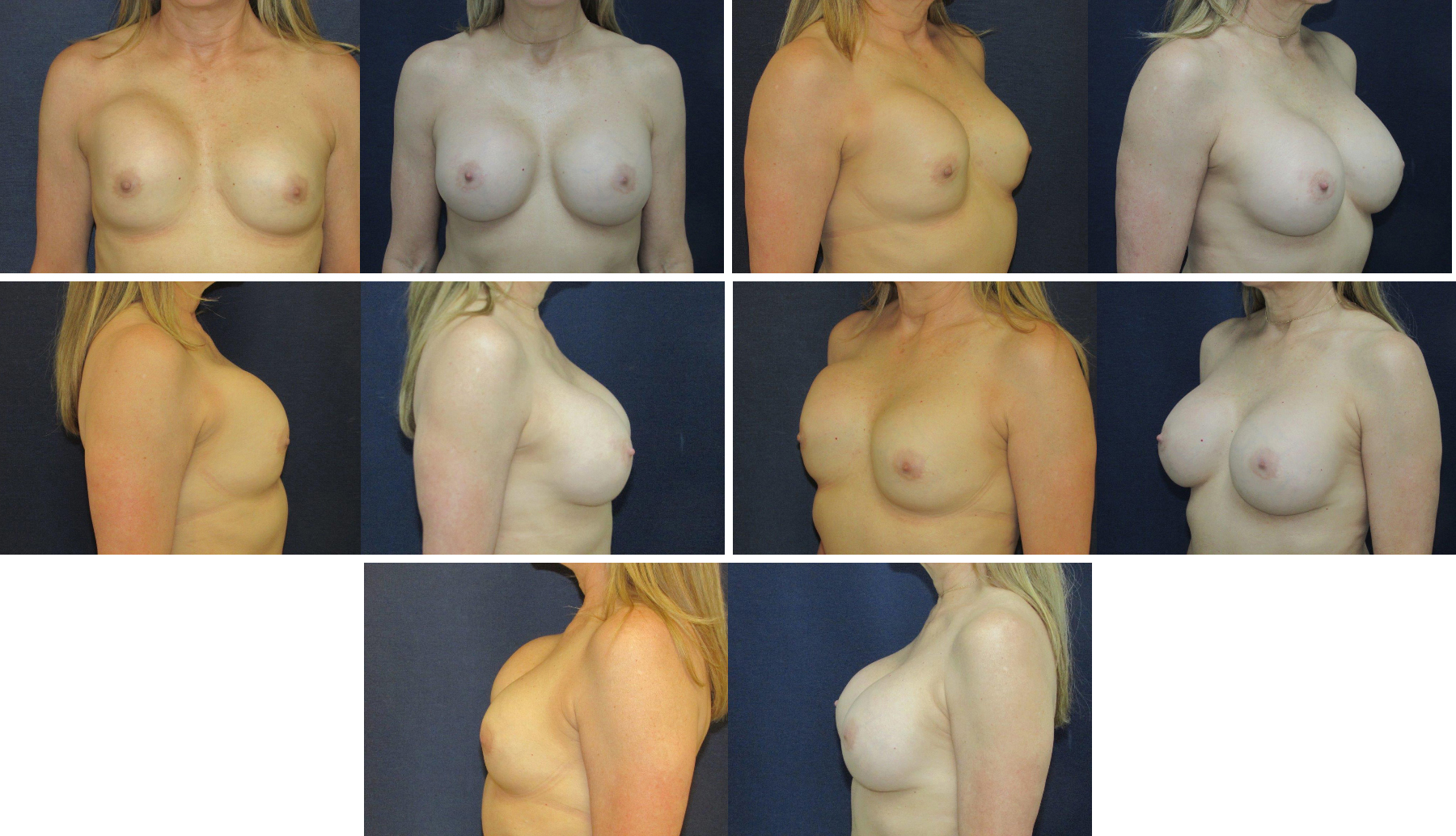 Before and After Image: Patient # 17823 - other