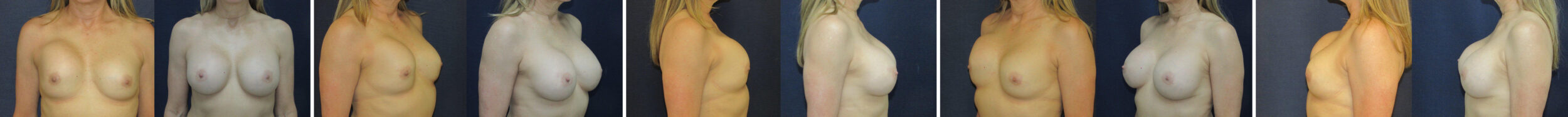 Before and After Image: Patient # 17823 - other