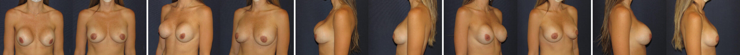 Before and After Image: Patient # 74861 - other