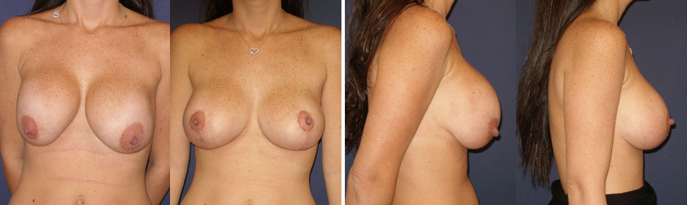 Before and After Image: Patient # 84076 - other