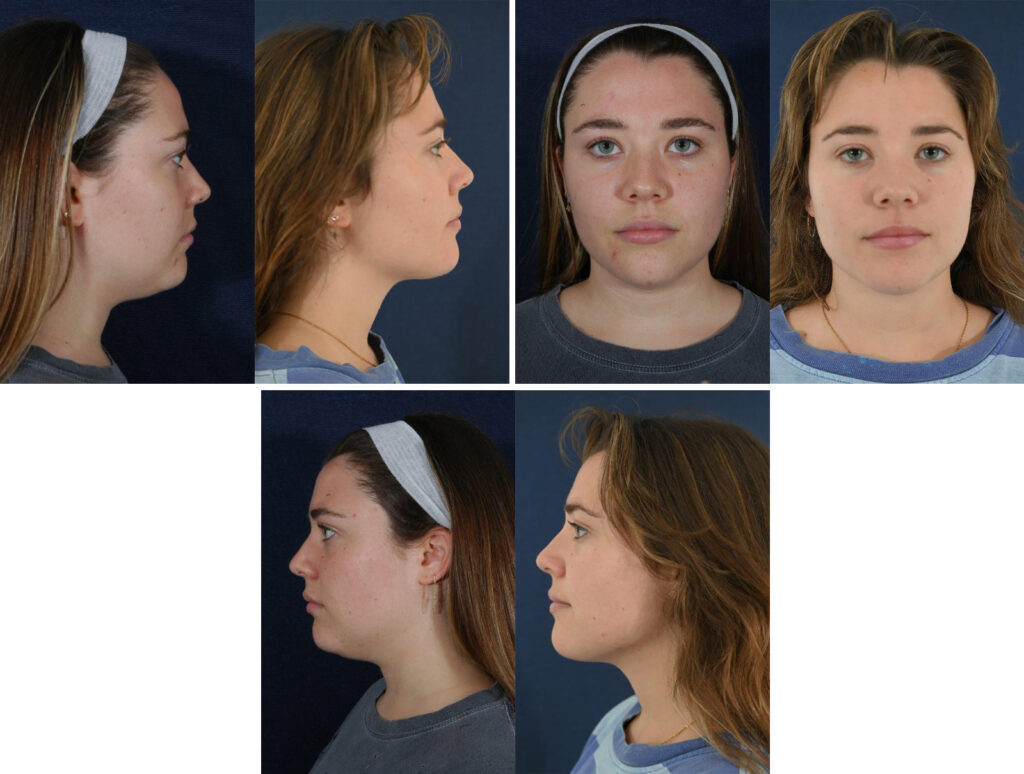 Before and After Image: Patient # 43786 - other