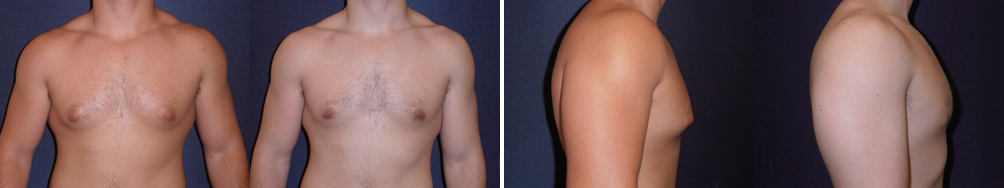 Before and After Image: Patient # 45146 - other