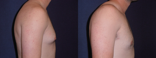 Before and After Image: Patient # 48046 - right-side