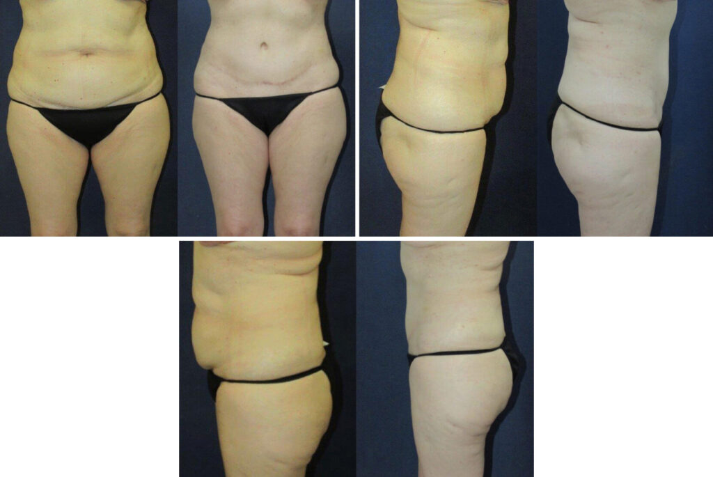 Before and After Image: Patient # 21993 - other