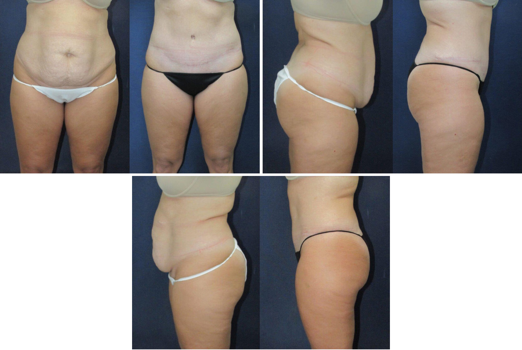 Before and After Image: Patient # 44376 - other