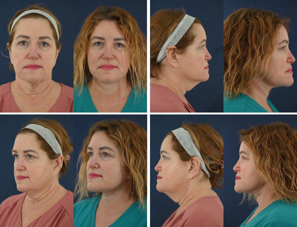 Before and After Image: Patient # 75345 - other