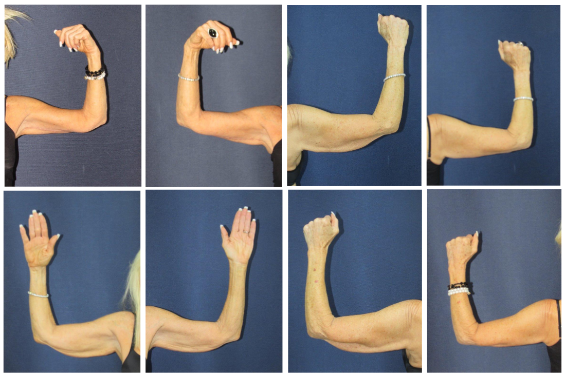 Before and After Image: Patient # 25339 - front